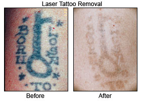 Tattoo Removal